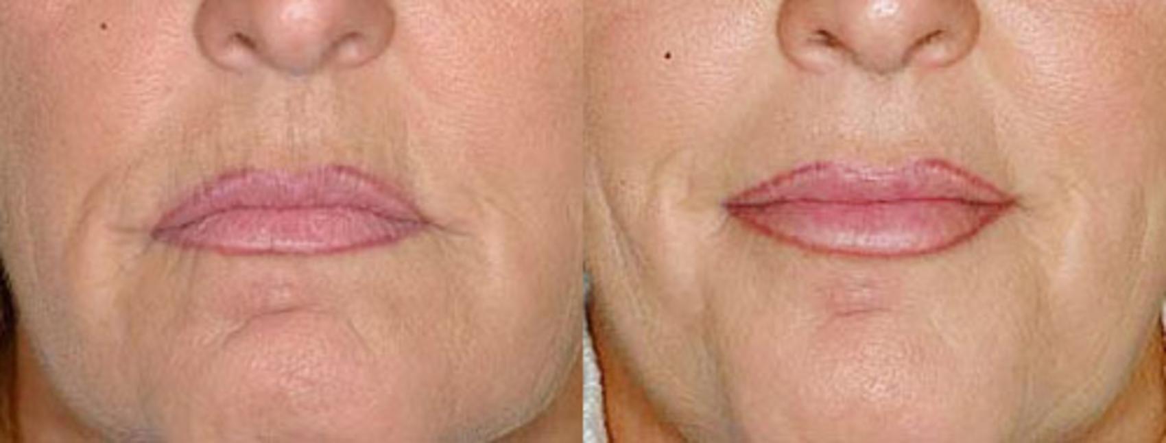 Lip Implants Case 94 Before & After View #1 | Louisville, KY | CaloSpa® Rejuvenation Center