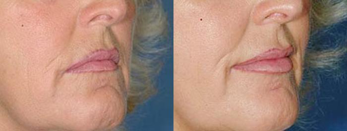 Before & After Lip Implants Case 94 View #2 View in Louisville & Lexington, KY