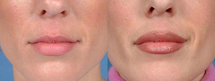Lip Implants Case 95 Before & After View #1 | Louisville, KY | CaloSpa® Rejuvenation Center