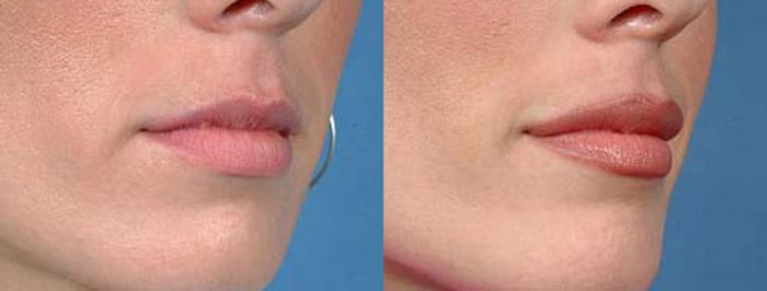 Before & After Lip Implants Case 95 View #2 View in Louisville & Lexington, KY
