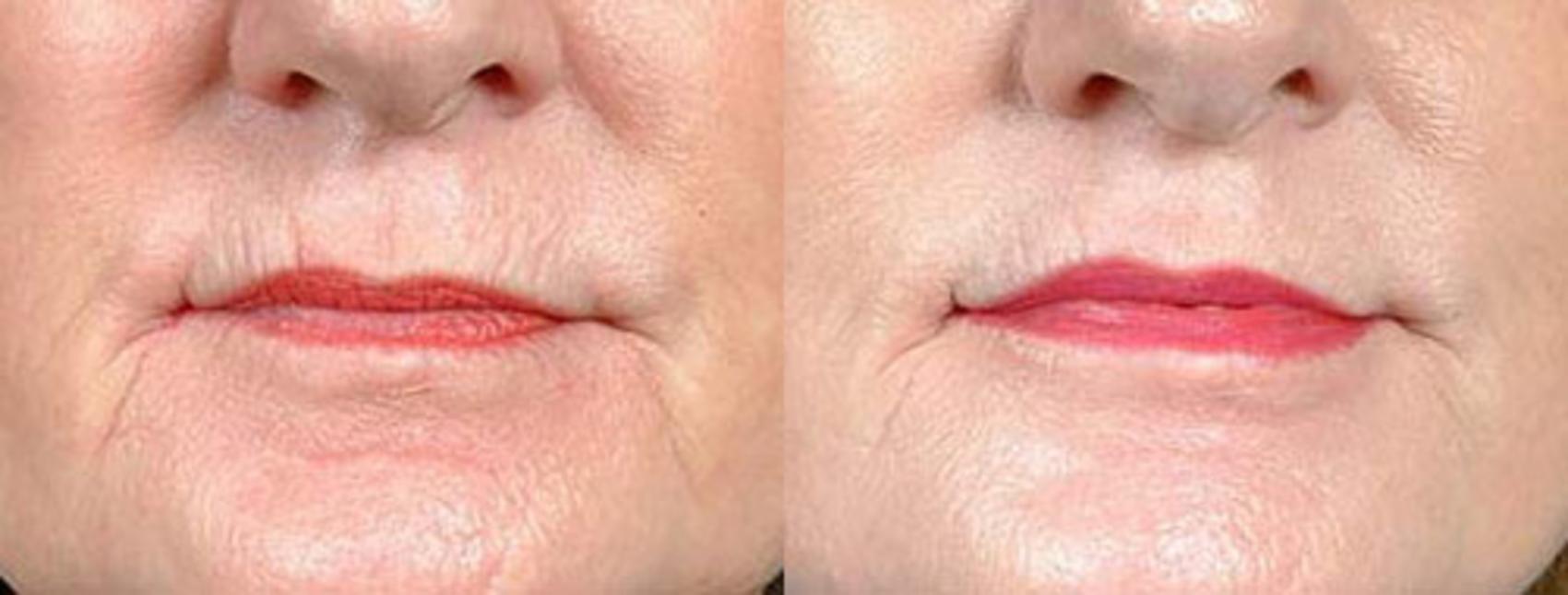 Lip Implants Case 96 Before & After View #1 | Louisville, KY | CaloSpa® Rejuvenation Center