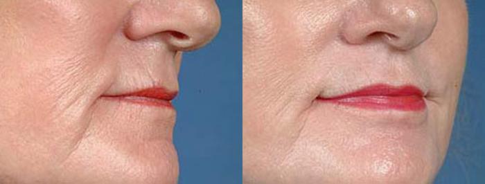 Lip Implants Case 96 Before & After View #2 | Louisville, KY | CaloSpa® Rejuvenation Center