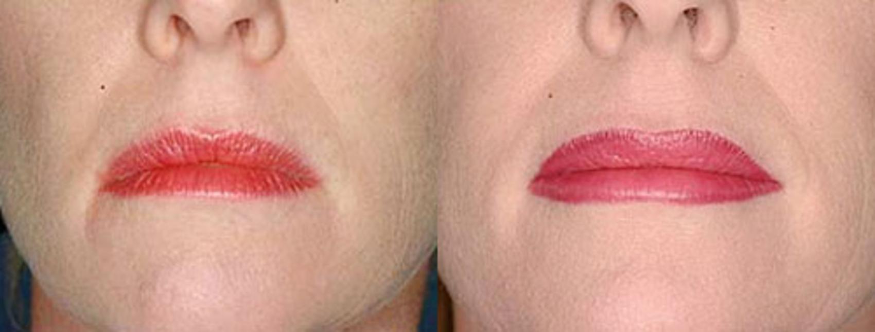 Lip Implants Case 97 Before & After View #1 | Louisville, KY | CaloSpa® Rejuvenation Center