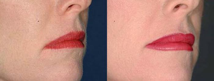 Lip Implants Case 97 Before & After View #2 | Louisville, KY | CaloSpa® Rejuvenation Center