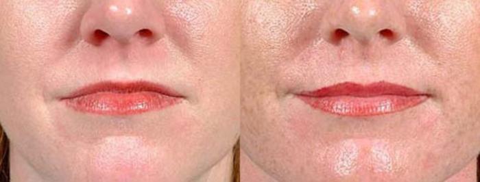 Lip Implants Case 98 Before & After View #1 | Louisville, KY | CaloSpa® Rejuvenation Center