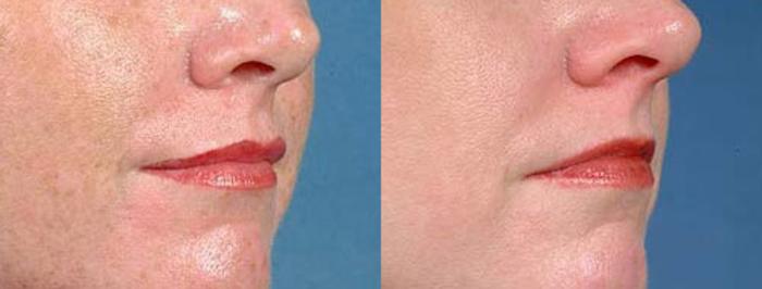 Before & After Lip Implants Case 98 View #2 View in Louisville & Lexington, KY