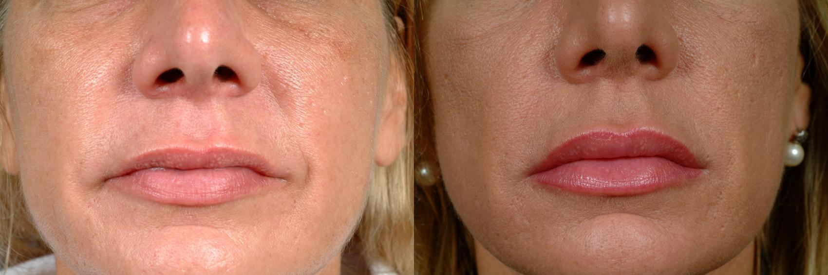 Before & After Dermal Fillers Case 624 Front View in Louisville & Lexington, KY