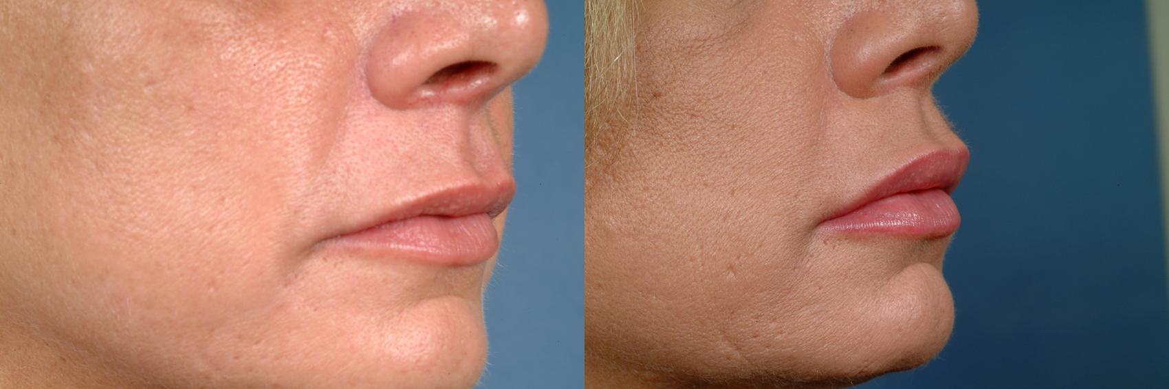 Before & After Lip Injections Case 624 Right Oblique View in Louisville & Lexington, KY