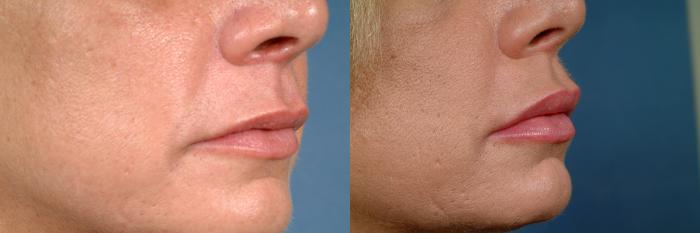 Before & After Dermal Fillers Case 624 Right Oblique View in Louisville & Lexington, KY