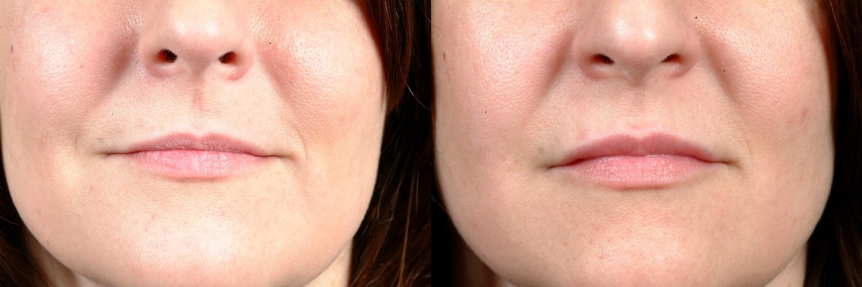 Before & After Dermal Fillers Case 625 Front View in Louisville, KY
