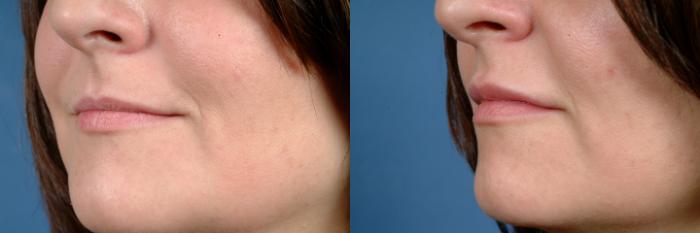 Before & After Dermal Fillers Case 625 Left Oblique View in Louisville & Lexington, KY