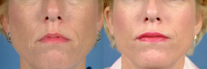 Before & After BOTOX® Cosmetic Case 626 Front View in Louisville & Lexington, KY