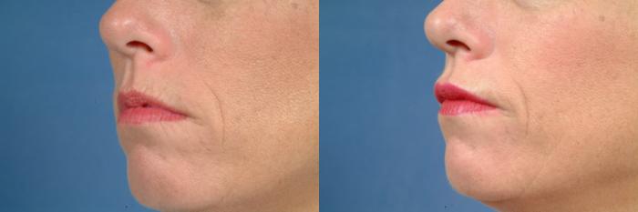 Before & After Lip Injections Case 626 Left Oblique View in Louisville & Lexington, KY