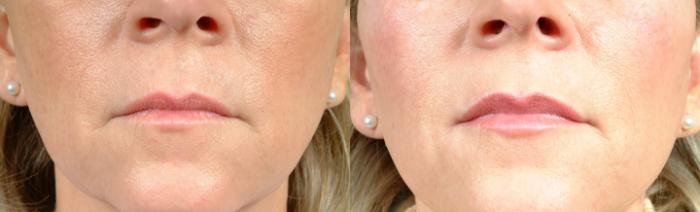 Before & After Dermal Fillers Case 628 Front View in Louisville & Lexington, KY