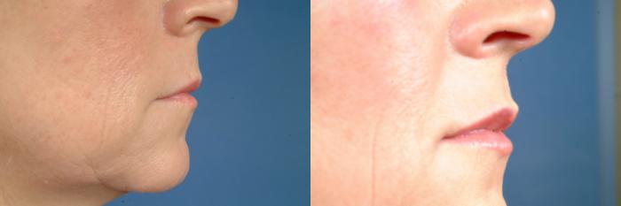Before & After Dermal Fillers Case 628 Right Side View in Louisville & Lexington, KY