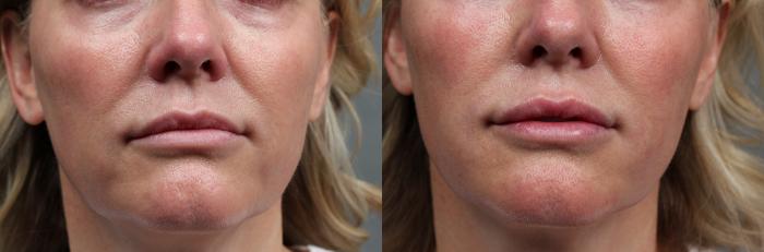 Before & After Dermal Fillers Case 629 Front View in Louisville & Lexington, KY