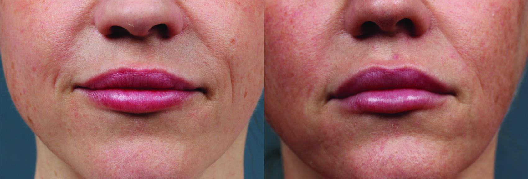 Before & After Dermal Fillers Case 632 Front View in Louisville & Lexington, KY