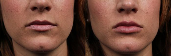 Before & After Lip Injections Case 633 Front View in Louisville & Lexington, KY