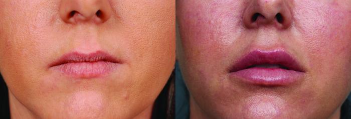 Before & After Dermal Fillers Case 635 Front View in Louisville & Lexington, KY