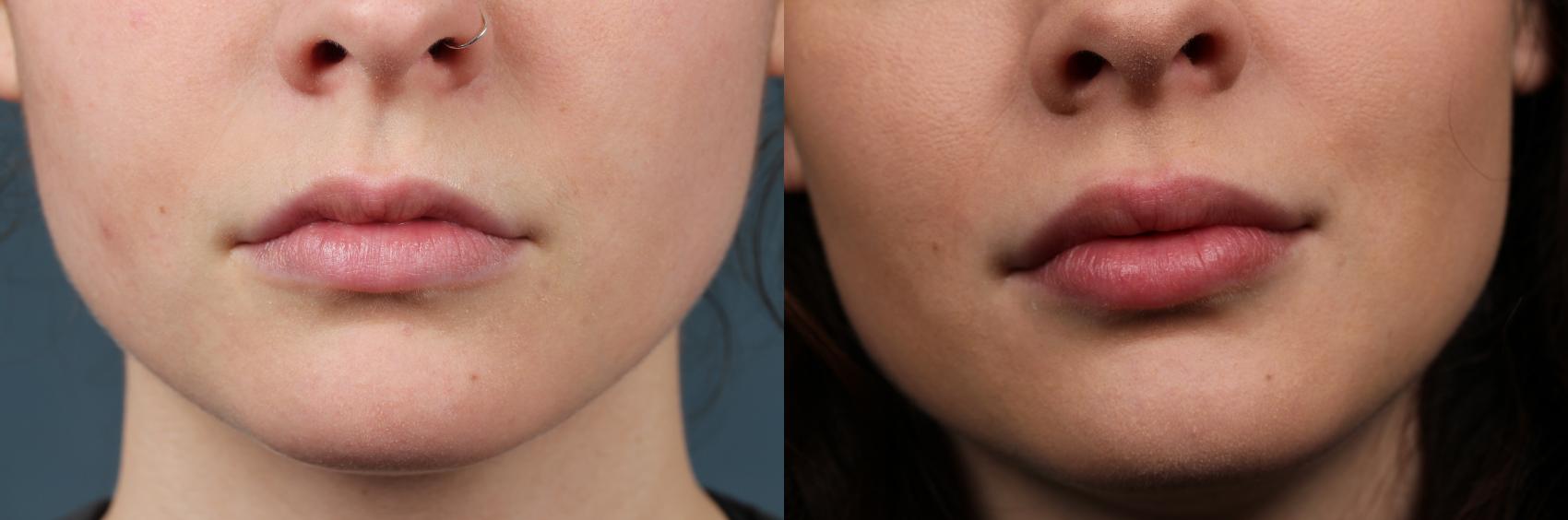 Before & After Dermal Fillers Case 643 Front View in Louisville, KY