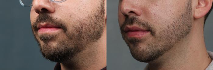 Lip Injections Case 644 Before & After Left Oblique | Louisville, KY | CaloSpa® Rejuvenation Center