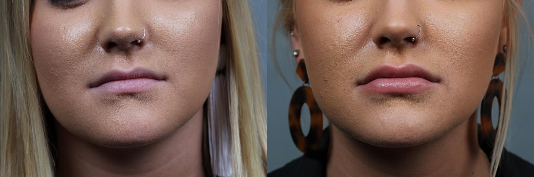 Before & After Dermal Fillers Case 647 Front View in Louisville & Lexington, KY