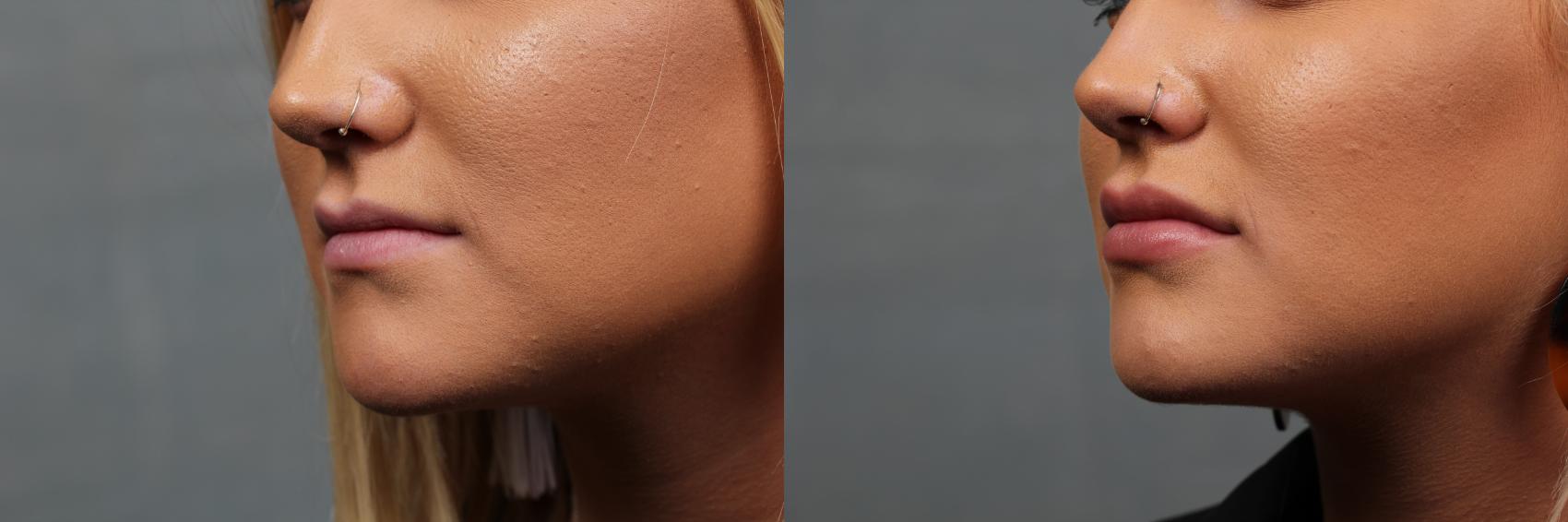 Dermal Fillers Before & After Photos Patient 647 Louisville