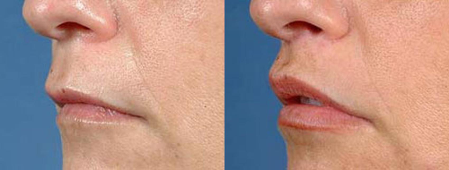 Before & After Lip Lift Case 90 View #2 View in Louisville & Lexington, KY