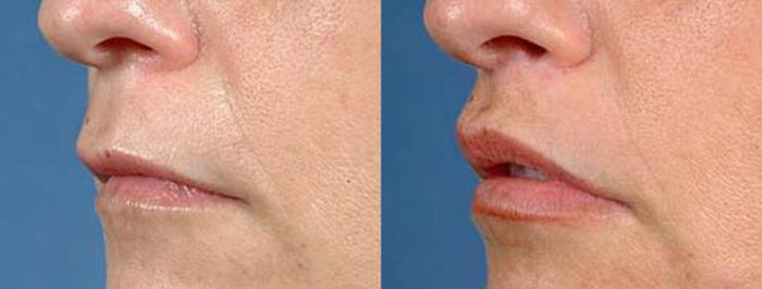 Before & After Lip Lift Case 90 View #2 View in Louisville & Lexington, KY
