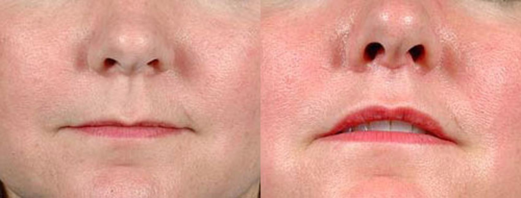 Before & After Lip Lift Case 91 View #1 View in Louisville & Lexington, KY