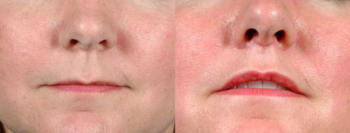 Before & After Lip Lift Case 91 View #1 View in Louisville, KY