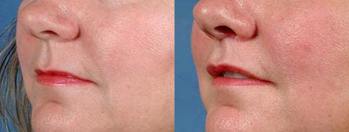 Lip Lift Case 91 Before & After View #2 | Louisville, KY | CaloSpa® Rejuvenation Center