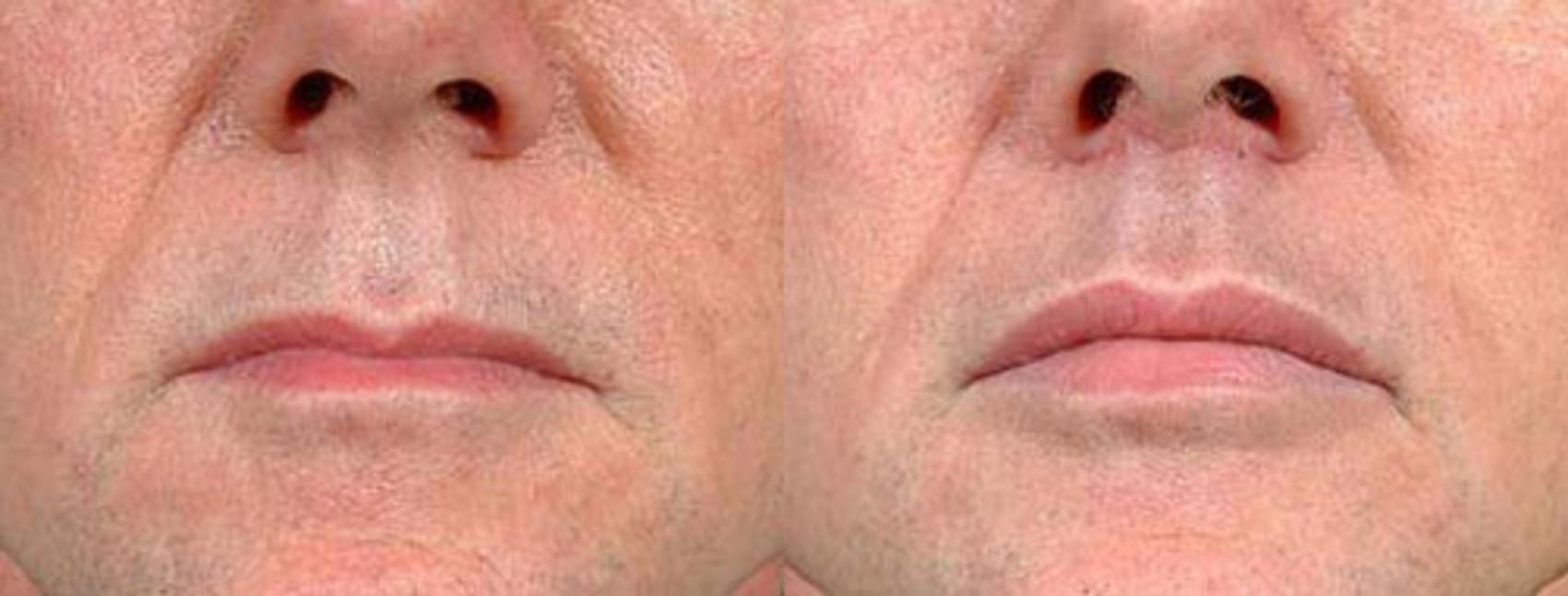 Before & After Lip Lift Case 92 View #1 View in Louisville & Lexington, KY