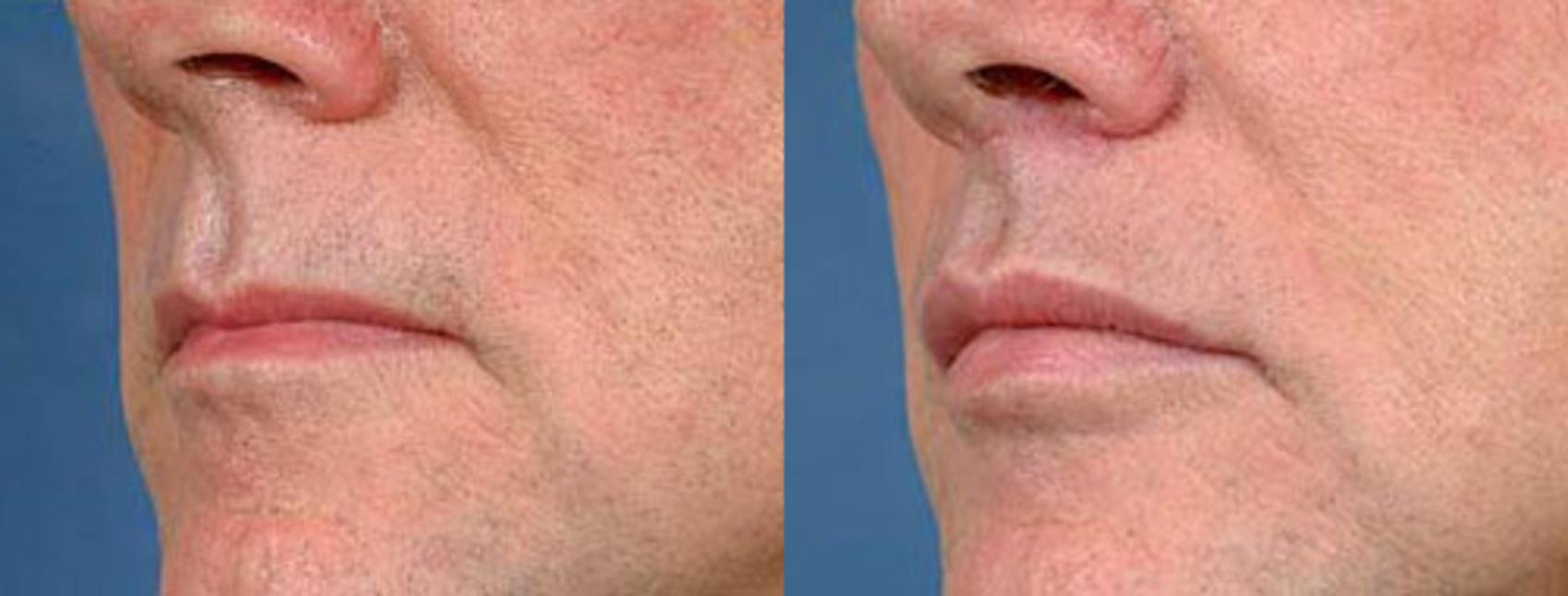 Before & After Lip Lift Case 92 View #2 View in Louisville & Lexington, KY