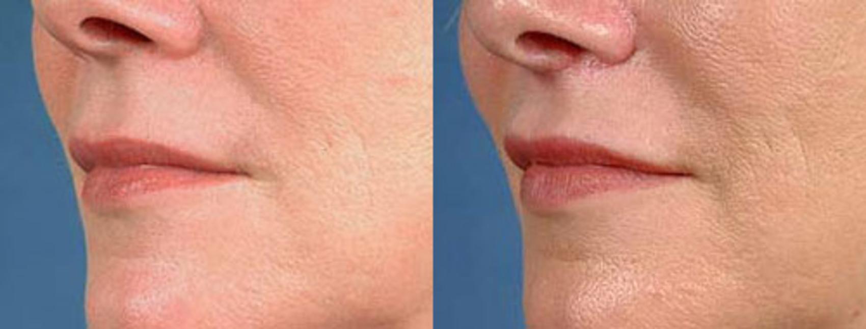 Before & After Lip Lift Case 93 View #1 View in Louisville & Lexington, KY