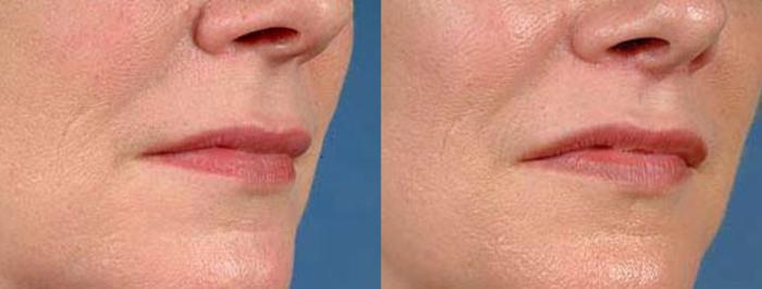 Before & After Lip Lift Case 93 View #2 View in Louisville & Lexington, KY
