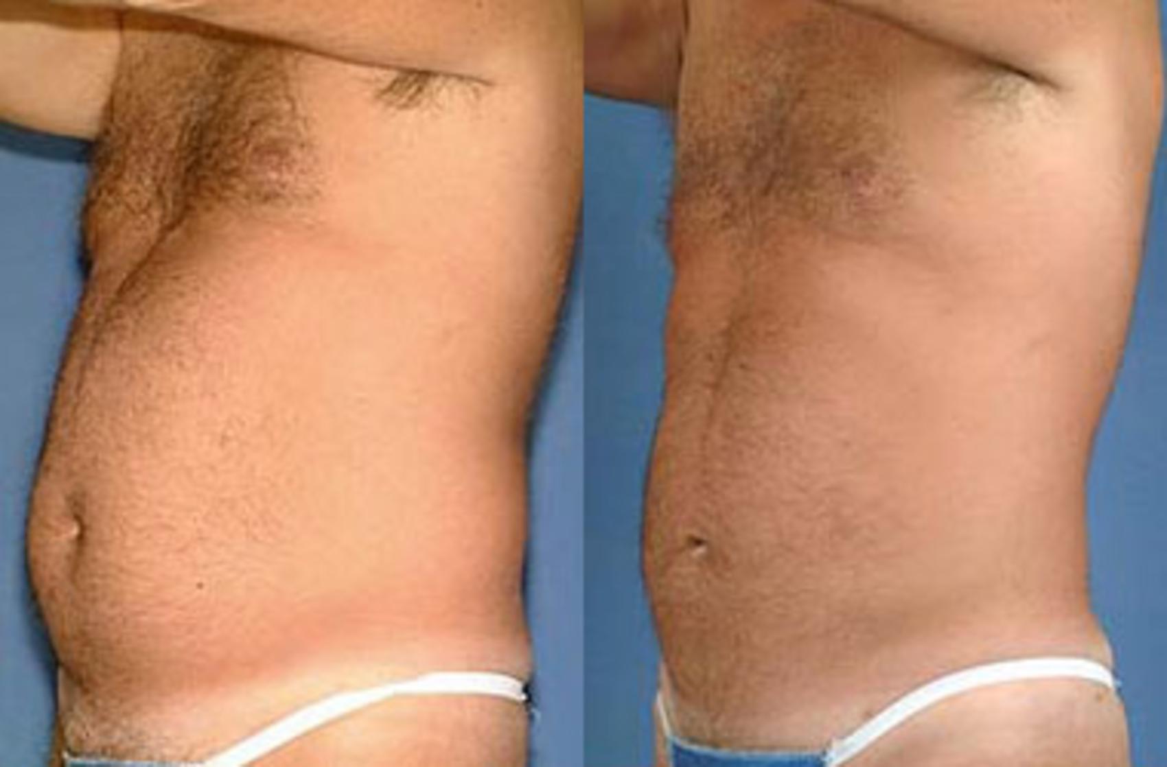 Before & After Liposuction for Men Case 115 View #1 View in Louisville, KY