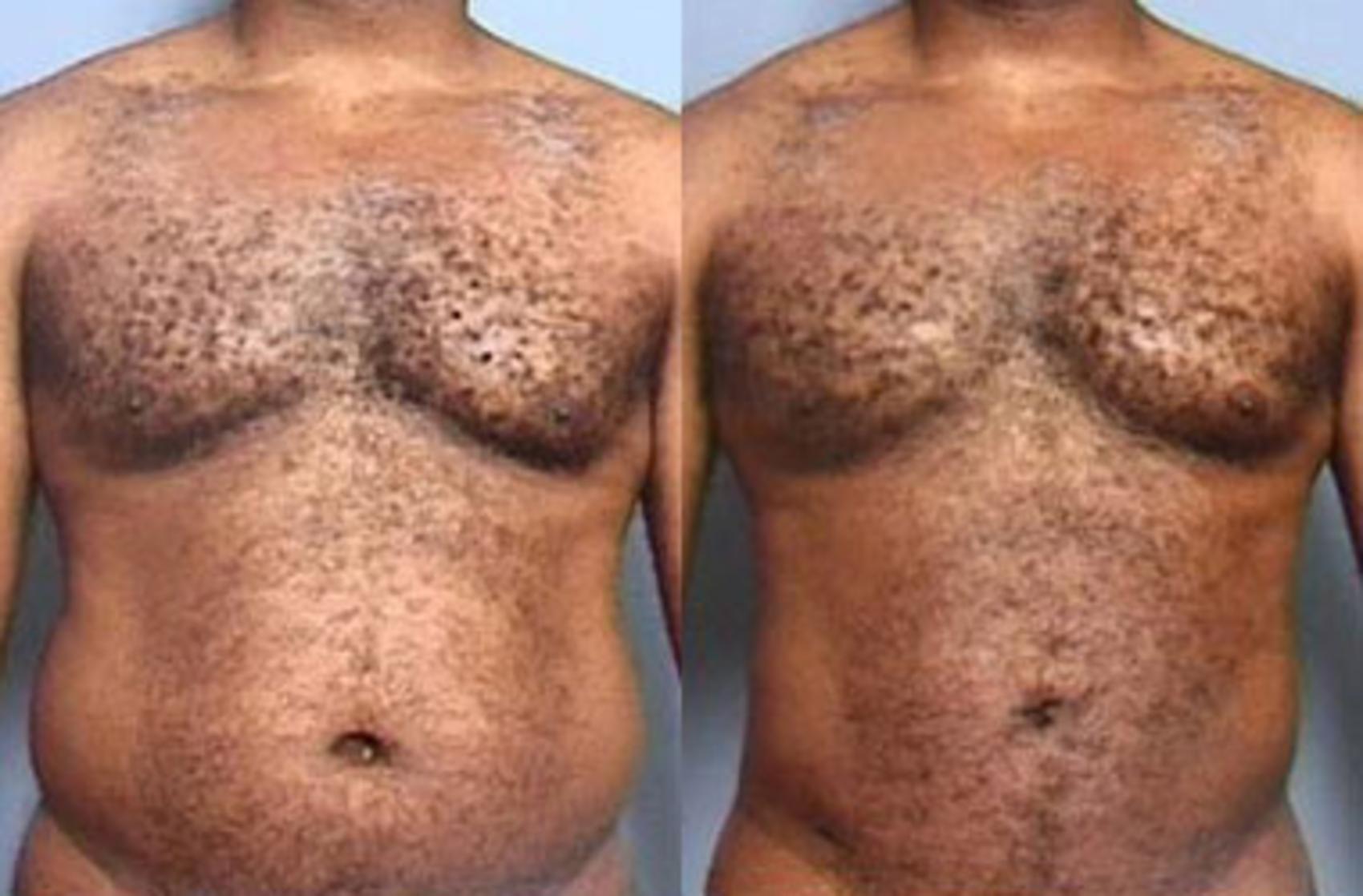 Before & After Liposuction for Men Case 117 View #1 View in Louisville, KY