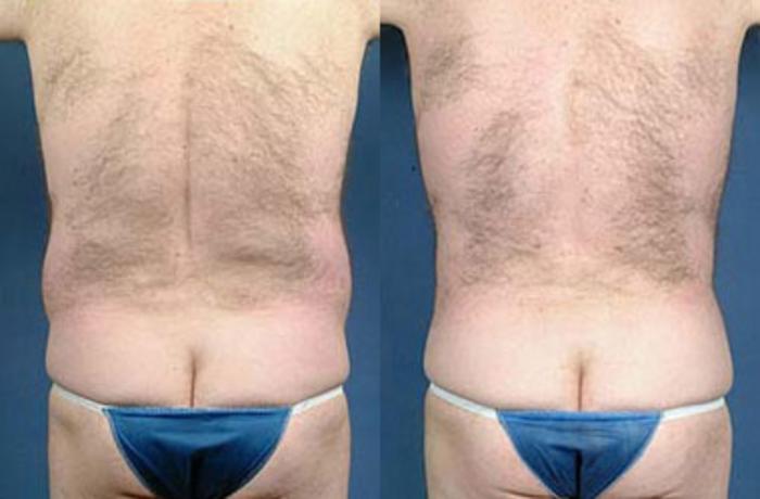 Before & After Liposuction for Men Case 119 View #2 View in Louisville & Lexington, KY