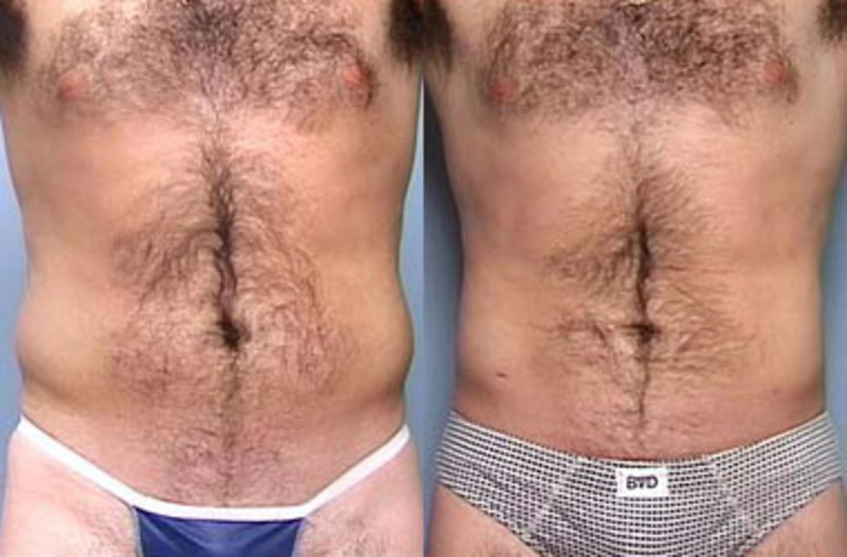 Before & After Liposuction for Men Case 121 View #1 View in Louisville, KY