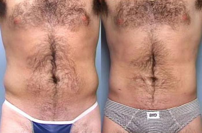 Before & After Liposuction for Men Case 121 View #1 View in Louisville & Lexington, KY
