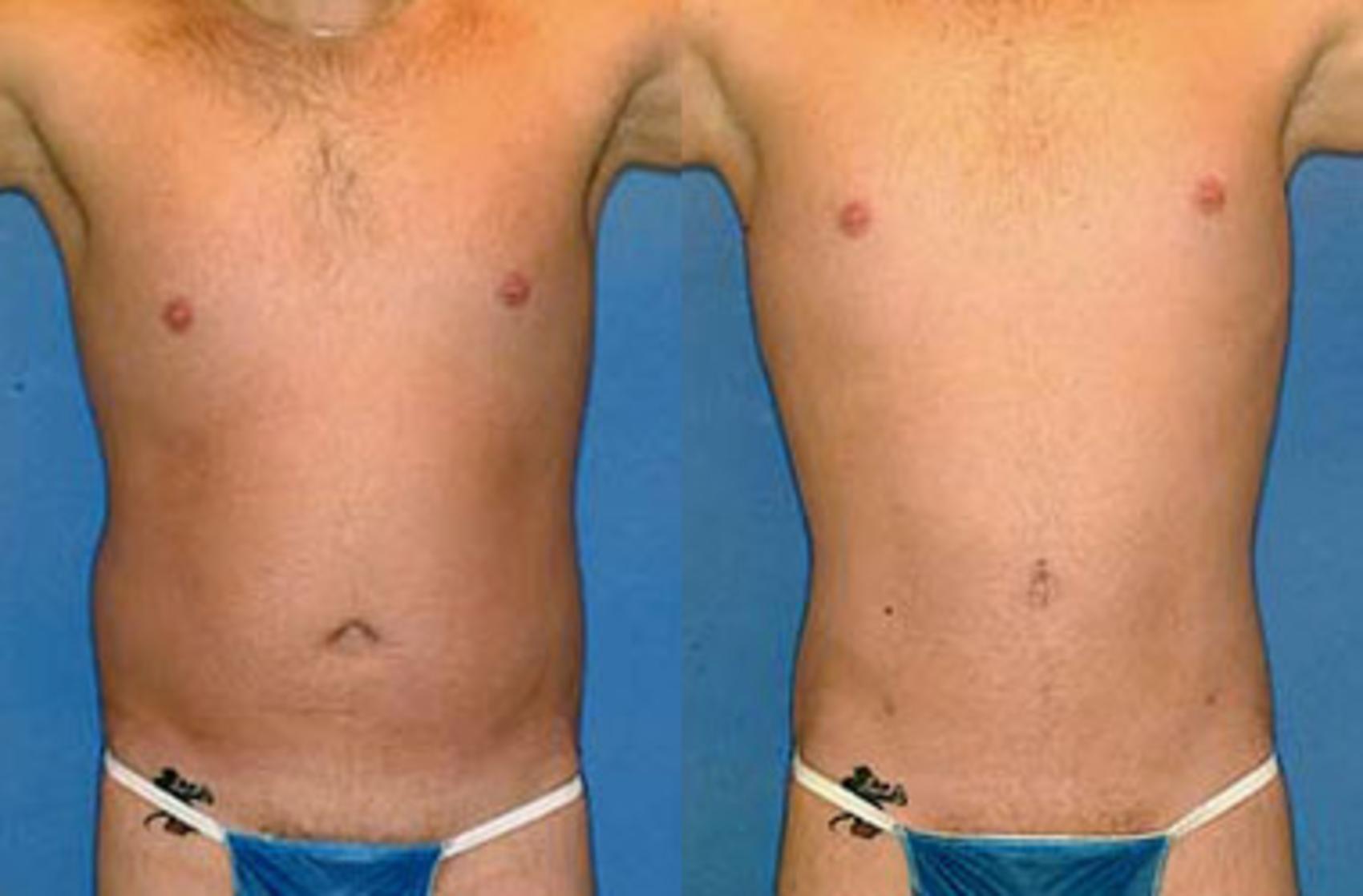 Before & After Liposuction for Men Case 123 View #1 View in Louisville, KY