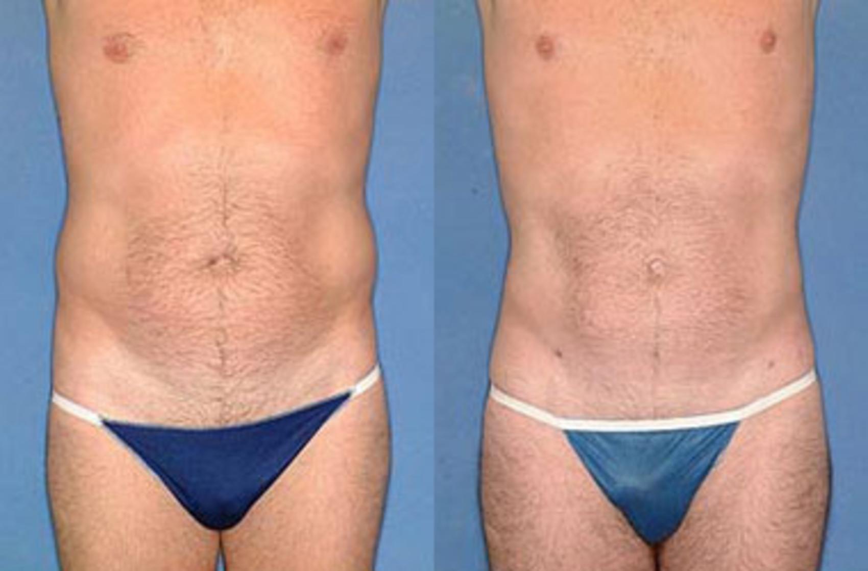 Before & After Liposuction for Men Case 126 View #1 View in Louisville, KY
