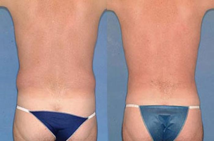 Before & After Liposuction for Men Case 126 View #2 View in Louisville & Lexington, KY