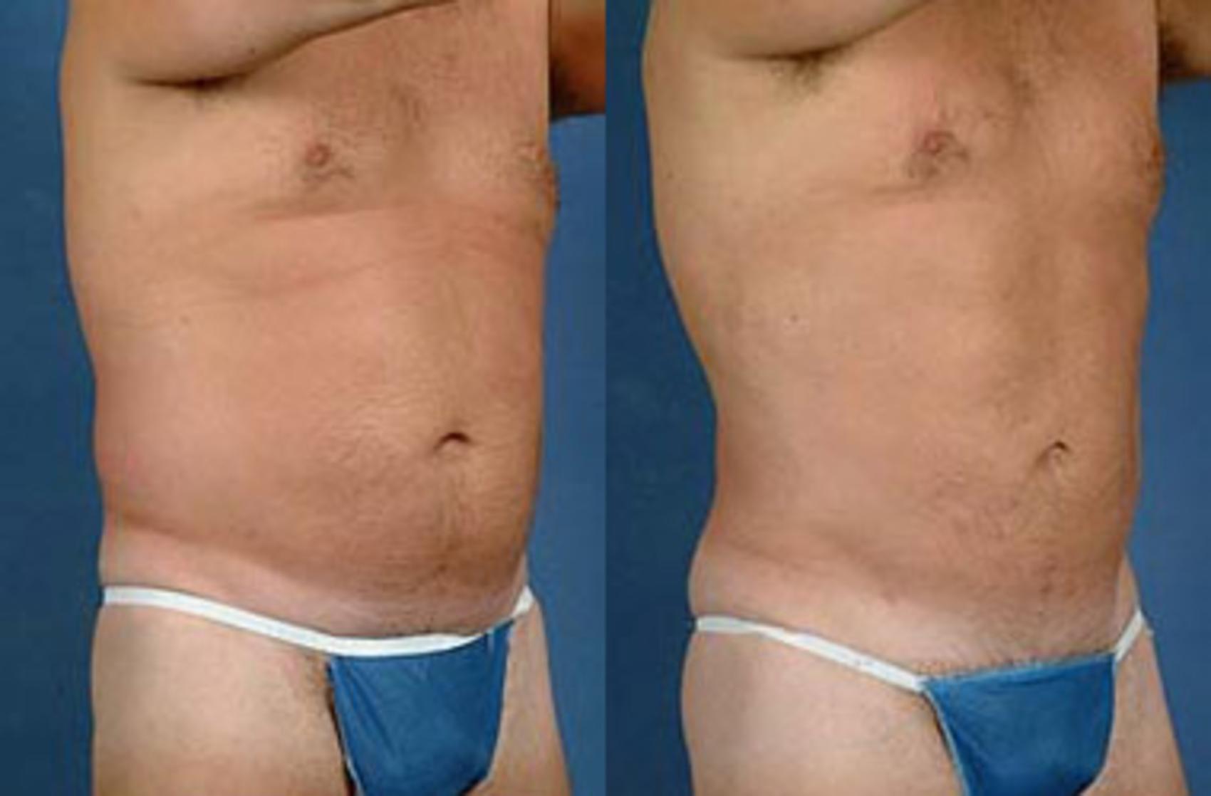 Before & After Liposuction for Men Case 129 View #1 View in Louisville, KY