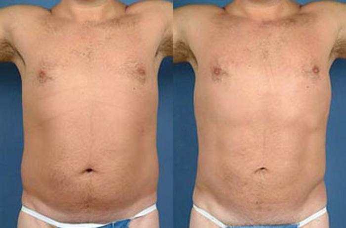 Before & After Liposuction for Men Case 129 View #2 View in Louisville & Lexington, KY