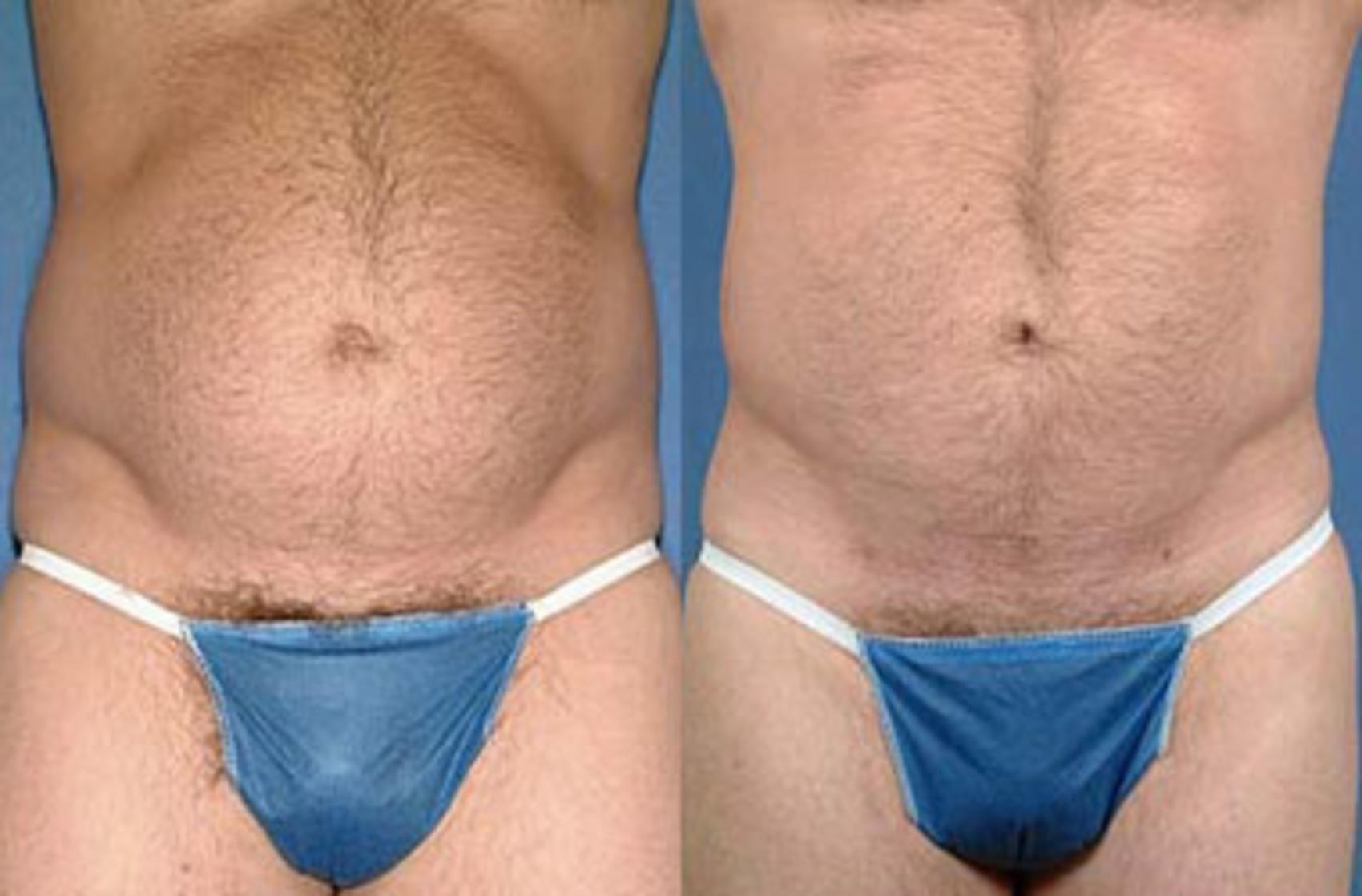 Before & After Liposuction for Men Case 131 View #1 View in Louisville & Lexington, KY