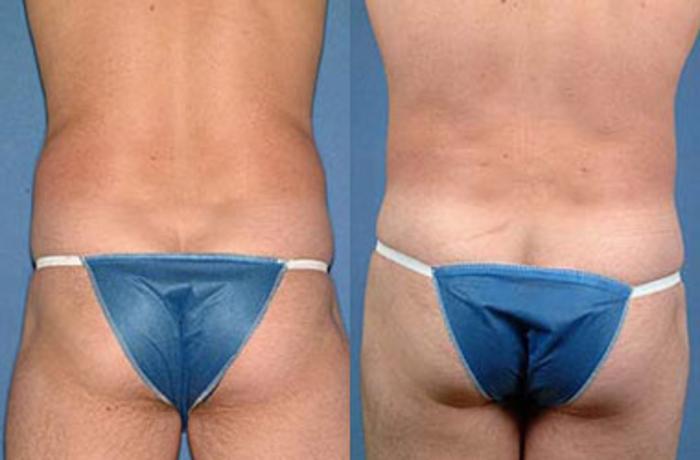 Before & After Liposuction for Men Case 131 View #2 View in Louisville & Lexington, KY
