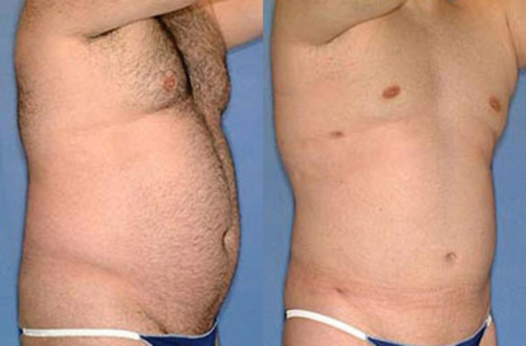 Before & After Liposuction for Men Case 134 View #1 View in Louisville, KY