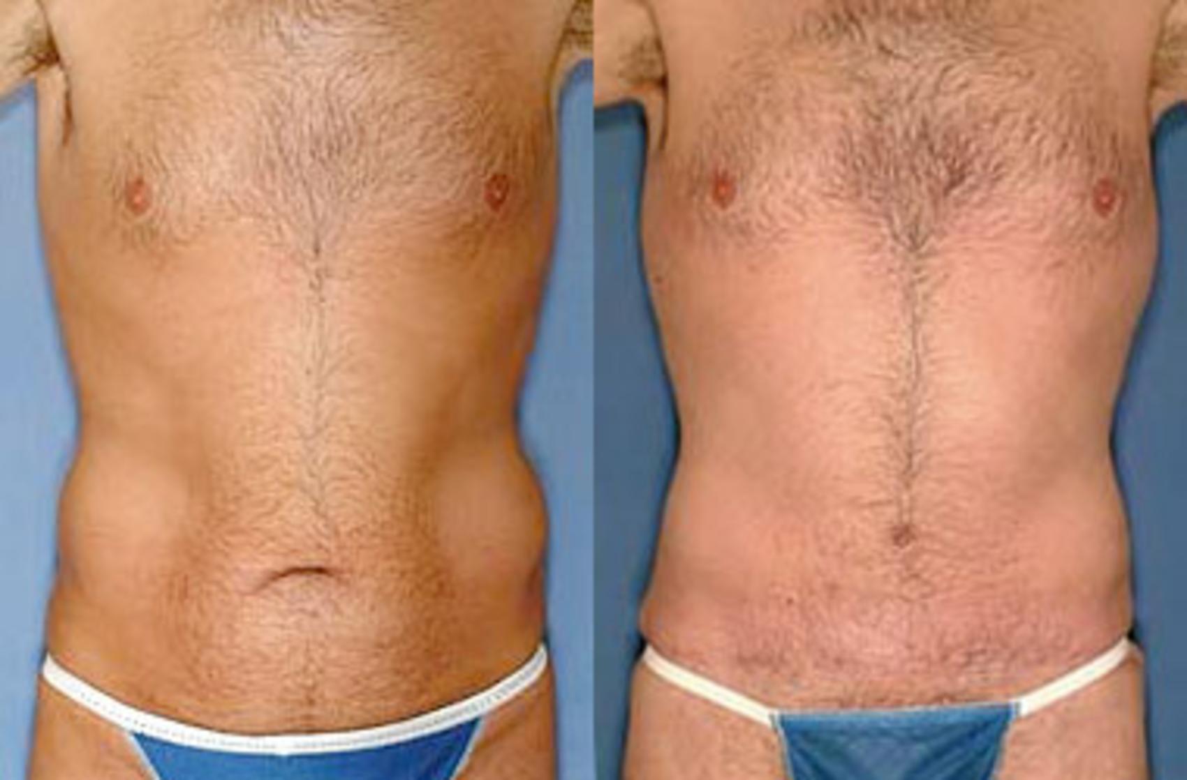 Before & After Liposuction for Men Case 149 View #1 View in Louisville, KY